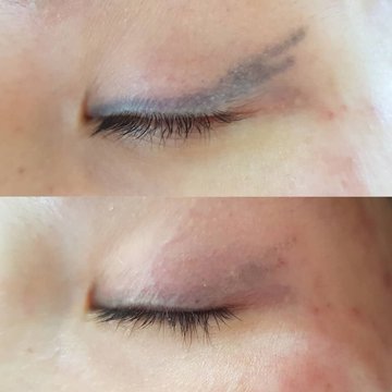 ремуверное удаление татуажа