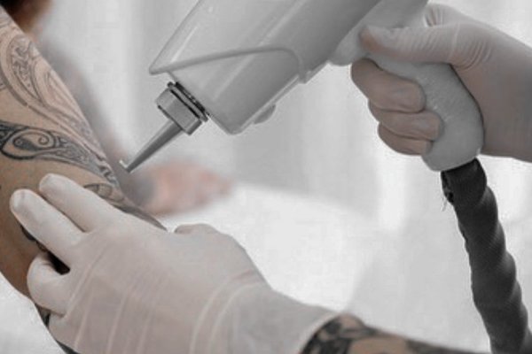 Видалення тату в Ірпені