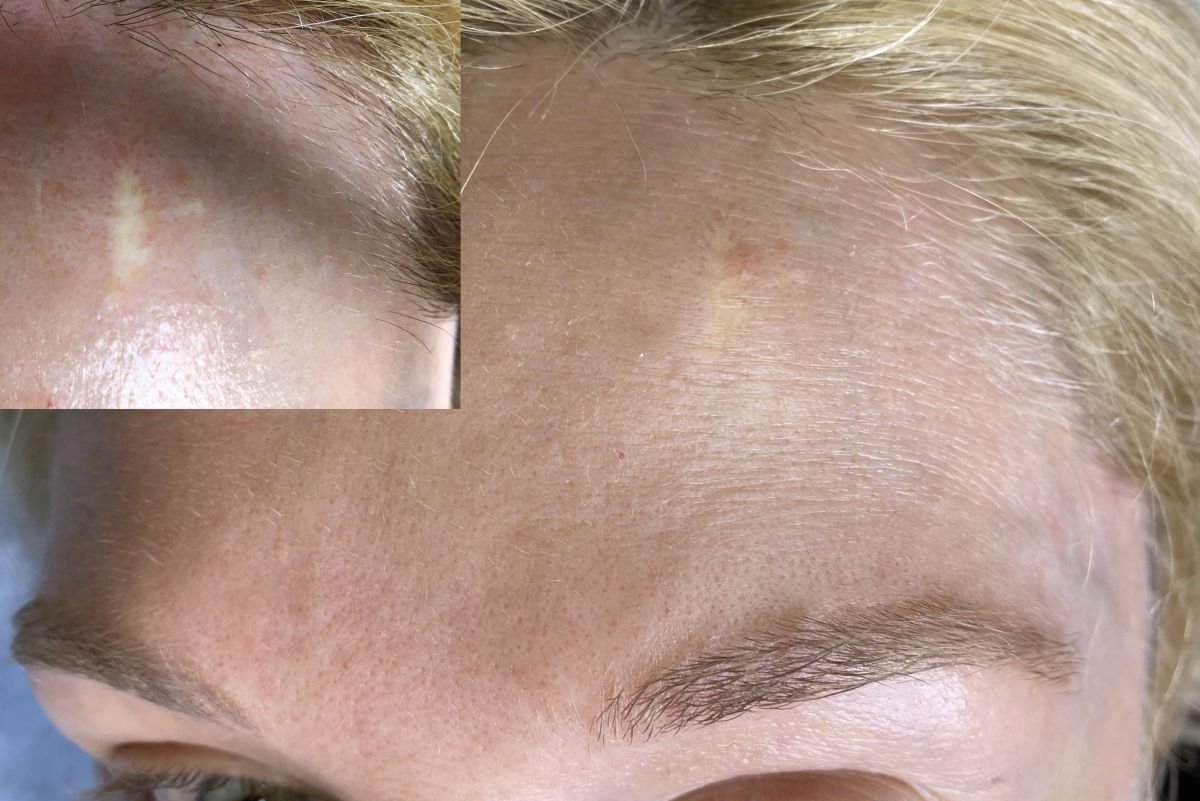 Татуаж на шрамах и рубцах