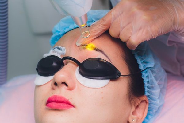 уход после удаления татуажа лазером