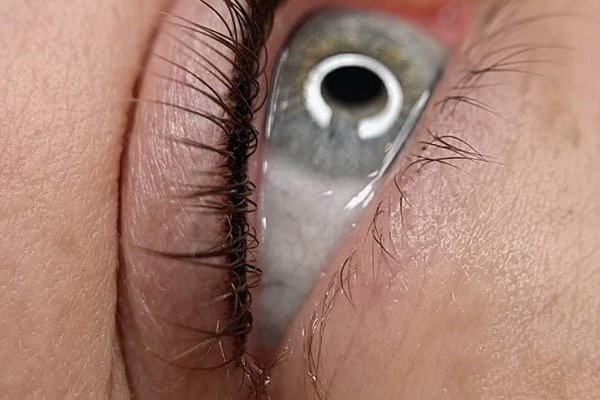 Safe method of tattoo removal