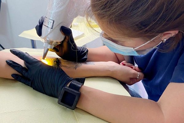 Удаление тату в Борисполе