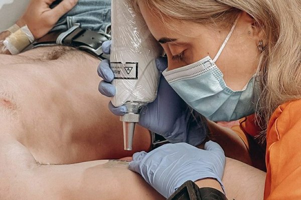 Удаление тату в Борисполе