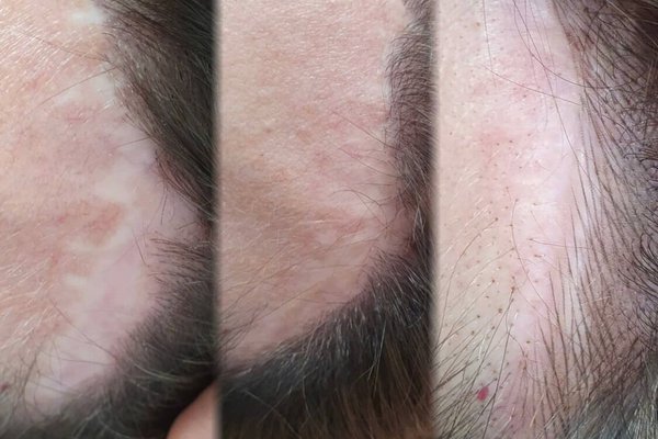 Татуаж на шрамах и рубцах