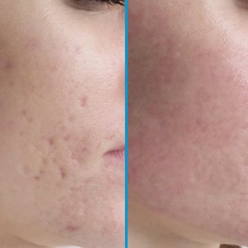 Татуаж на шрамах и рубцах