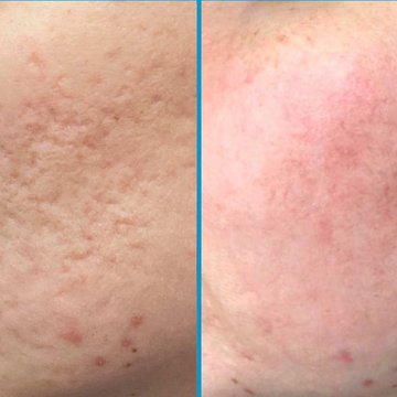 Татуаж на шрамах и рубцах