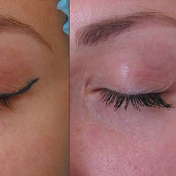 удаление ремувером стрелок