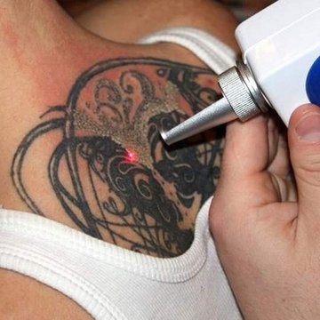 удаление тату лазером