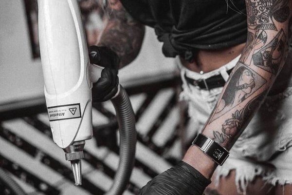 Laser tattoo removal in Kiev