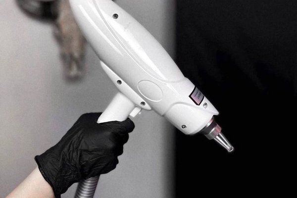 Laser tattoo removal in Kiev
